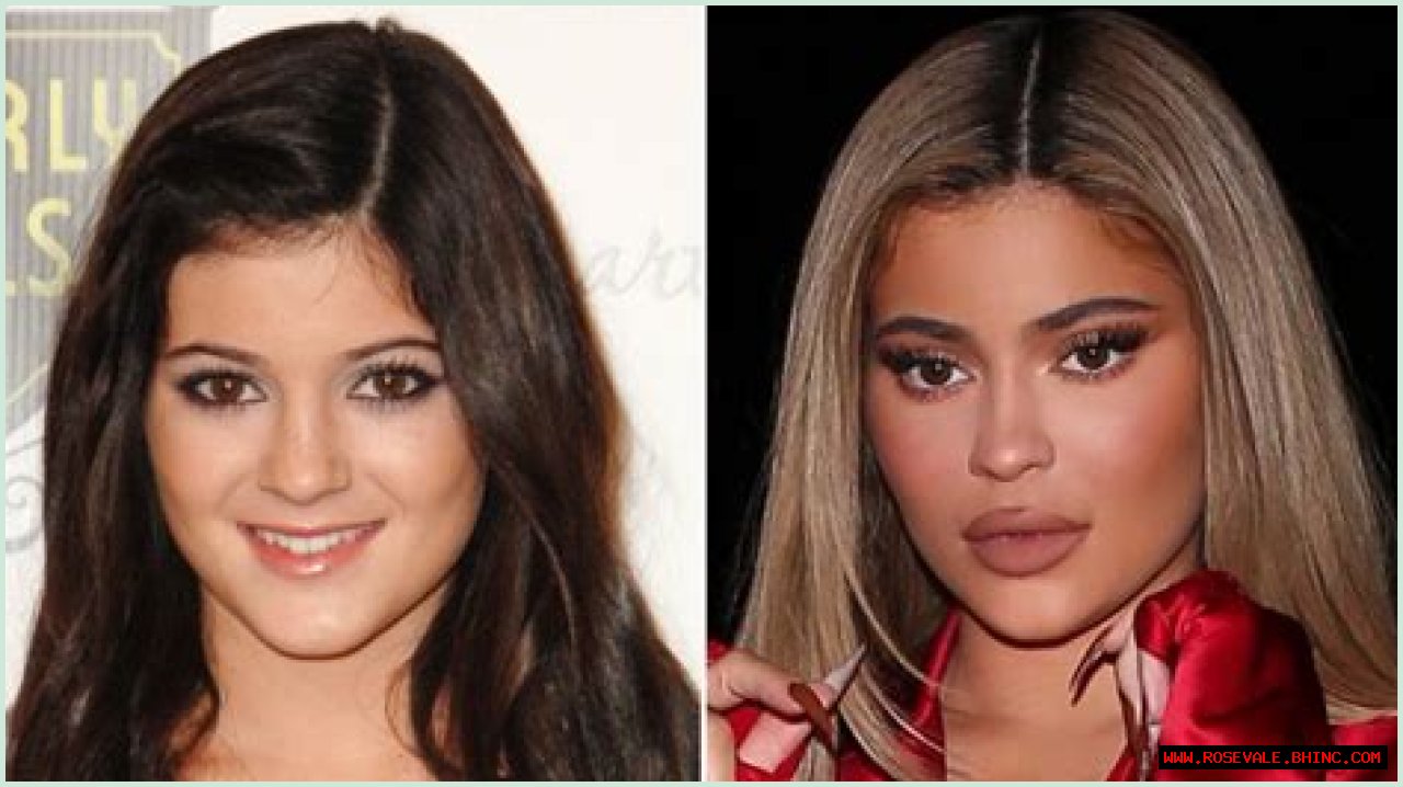 Kylie Jenner Is No Stranger to Plastic Surgery: Her Transformation Before and After Lip Fillers