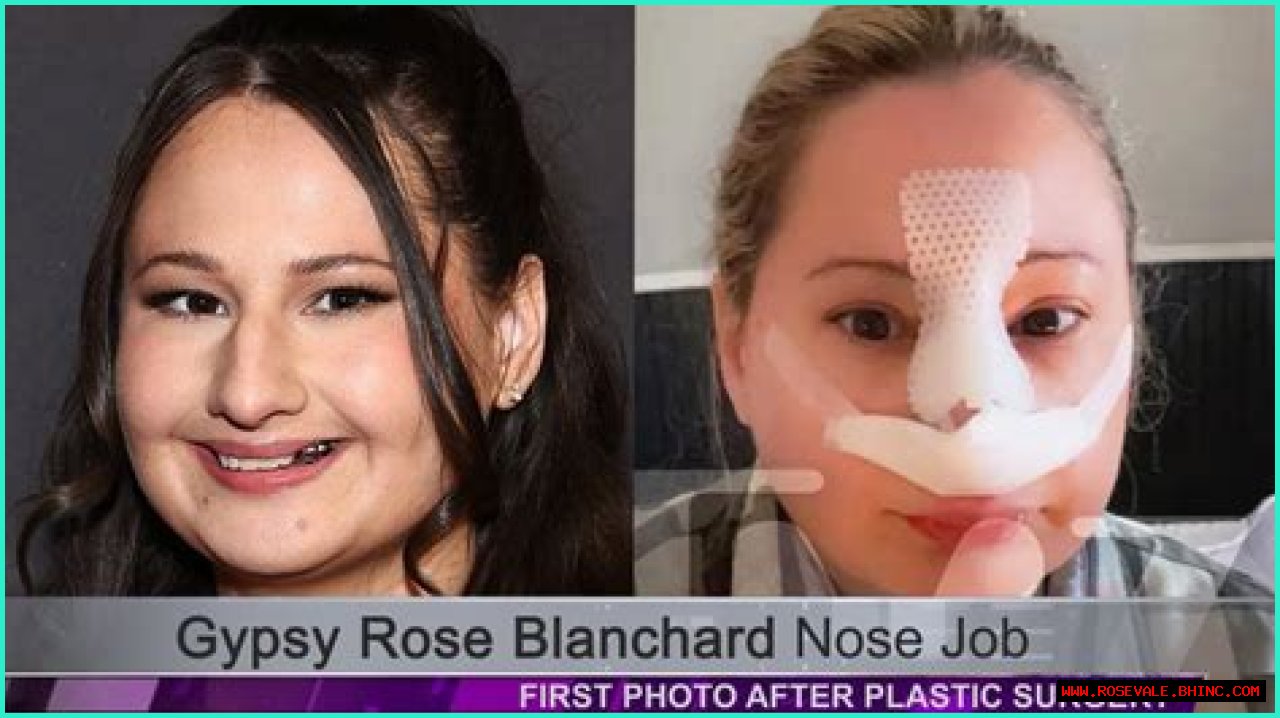 Unveiling The Transformation: The Nose Job Of Gypsy Rose